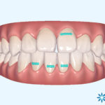 インビザラインのクリンチェック