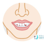 すきっ歯になる原因は?