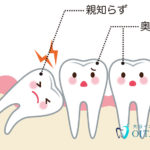 親知らずの知識とケア方法