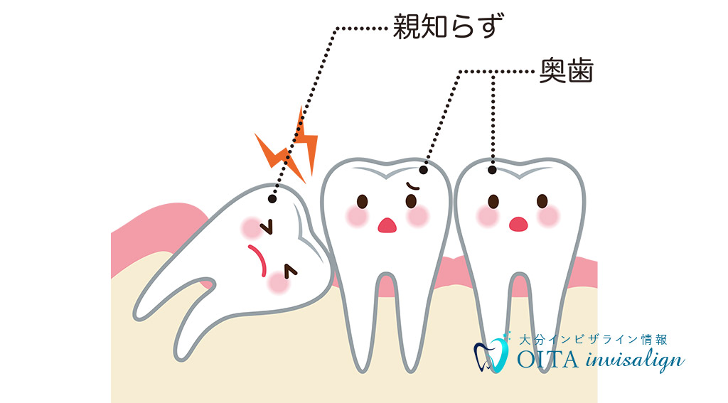 親知らずの知識とケア方法