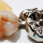 昔の歯科治療はどんな感じ？