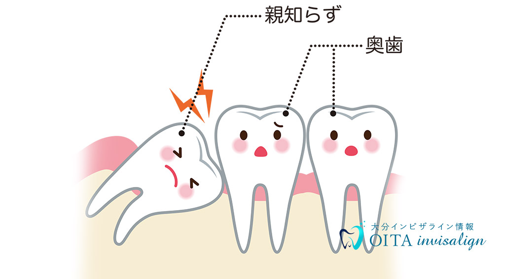 顔 親知らず 小 抜い たら