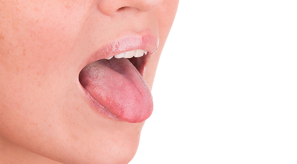 舌癌（舌ガン）