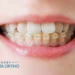 ハーフリンガル矯正