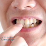 放っておくと危険な交叉咬合